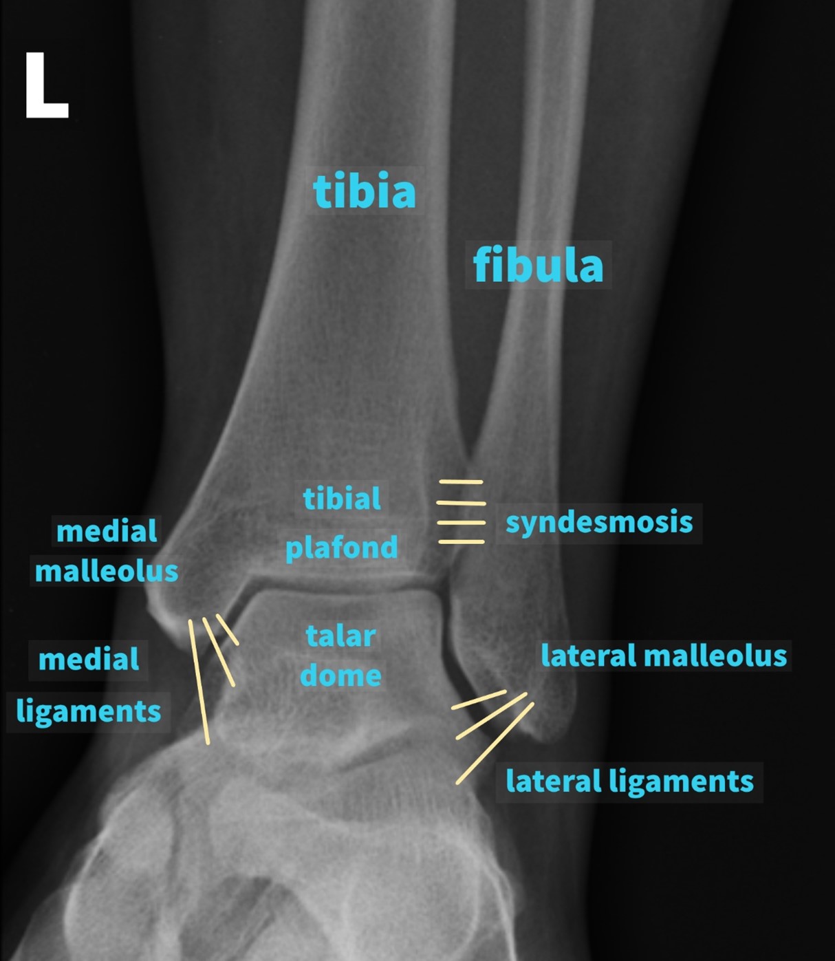 Ankle X-ray Interpretation, Ankle Fracture