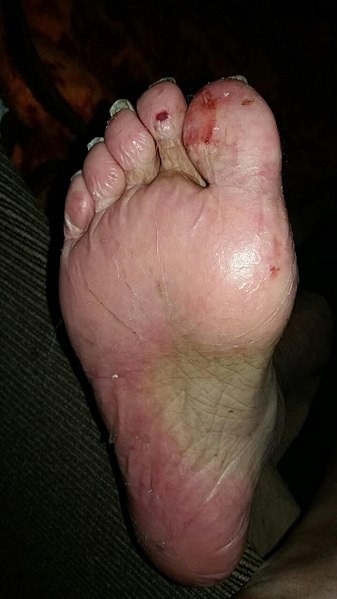  Palmar plantar erythrodysesthesia affecting the foot