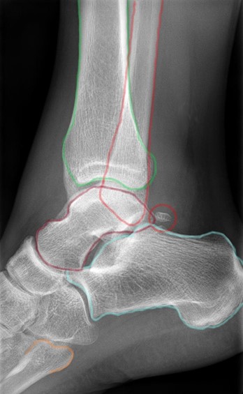Understanding an Ankle Fracture