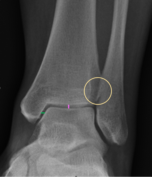 normal ankle xray
