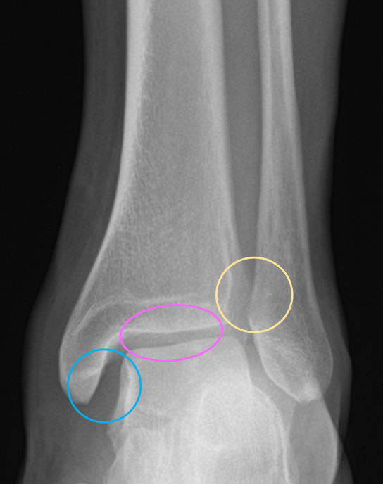 Ankle X Ray Interpretation Ankle Fracture Geeky Medics