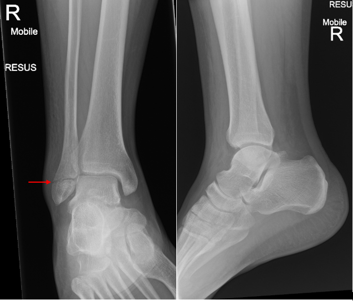 Ankle X-ray Interpretation