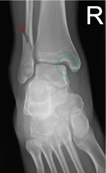 talus bone x ray