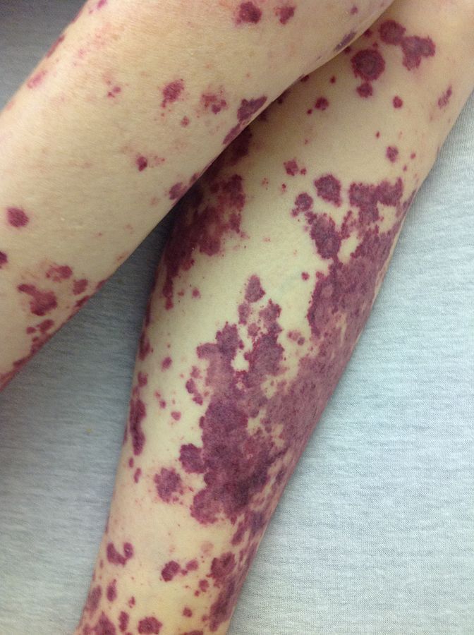 Petechial rash, which can occur in COVID-19