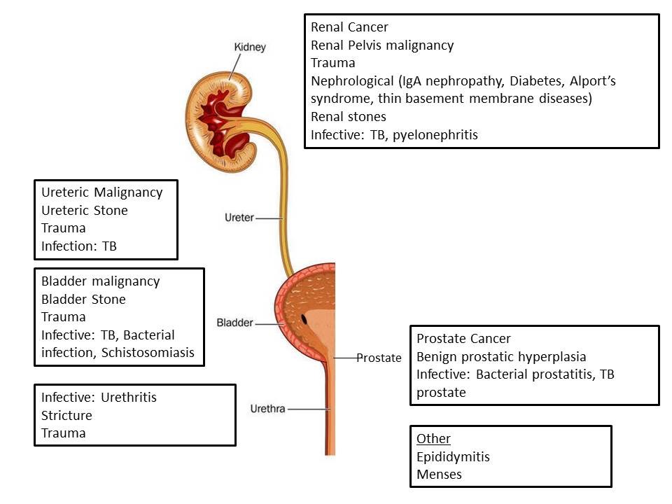 BNO – Az urogenitális rendszer megbetegedései – Wikipédia - Prostatitis MicroHematuria