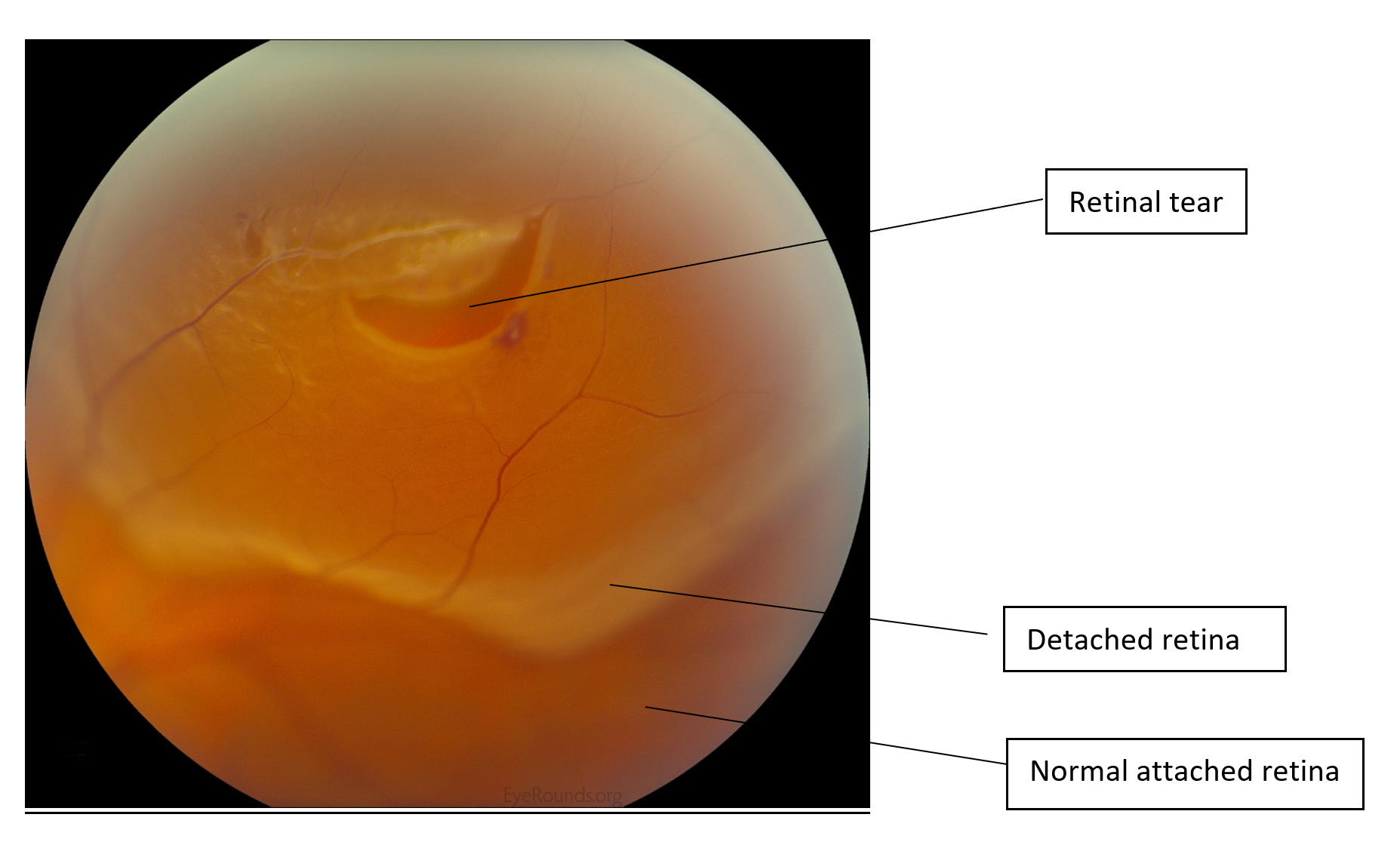 webmd detached retina symptoms