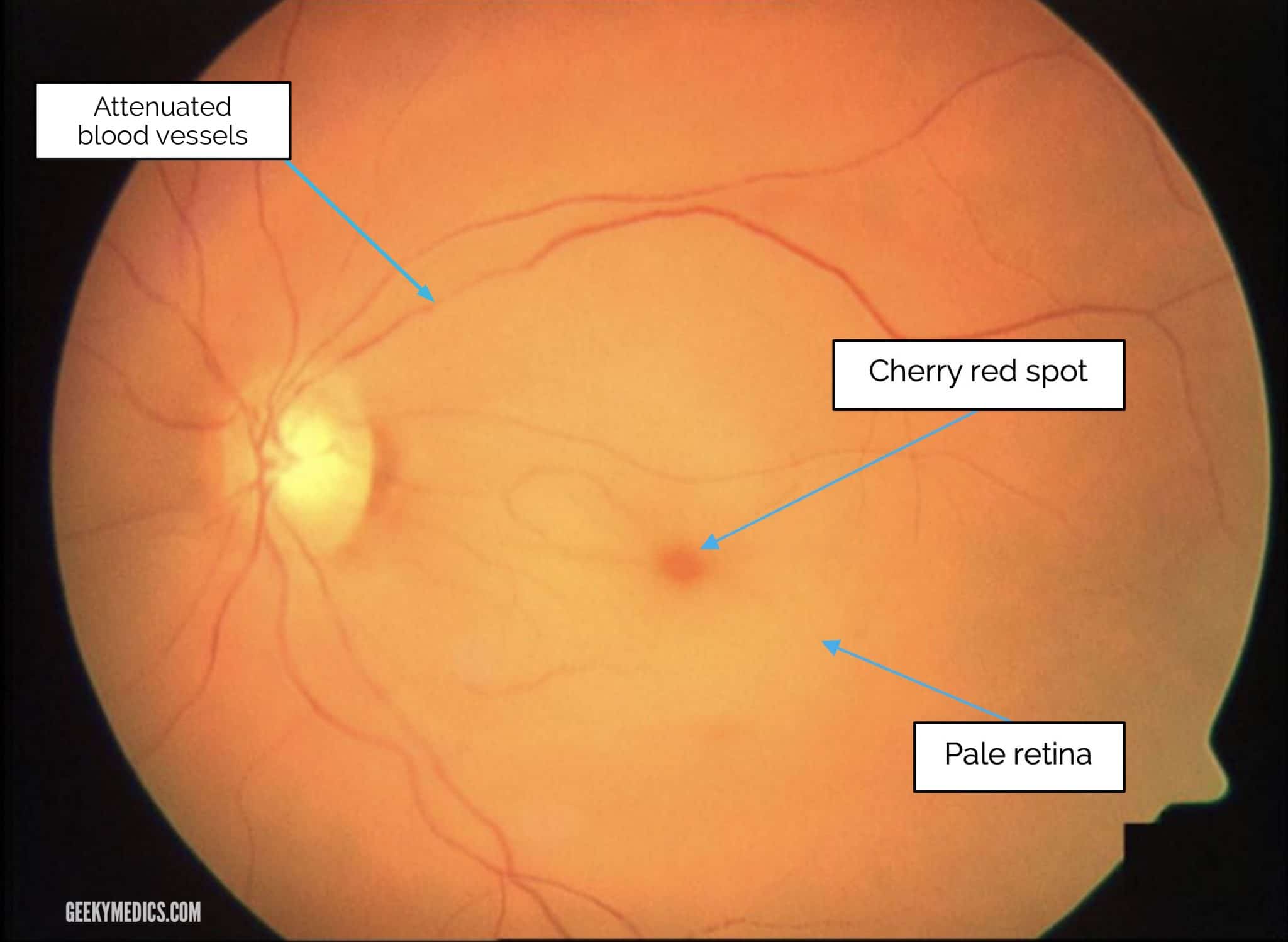 normal retina exam feathre