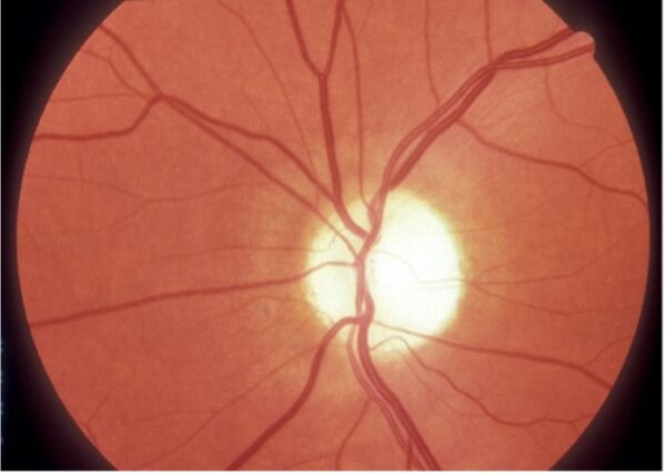 Optic disc pallor as seen in cases of resolved optic neuritis