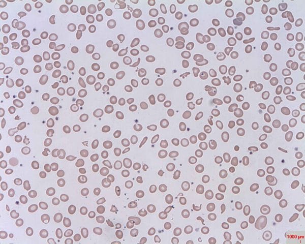 A blood film showing schistocytes