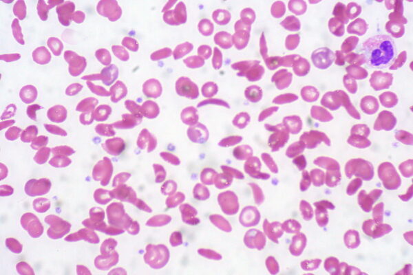 Sickle cell anaemia.