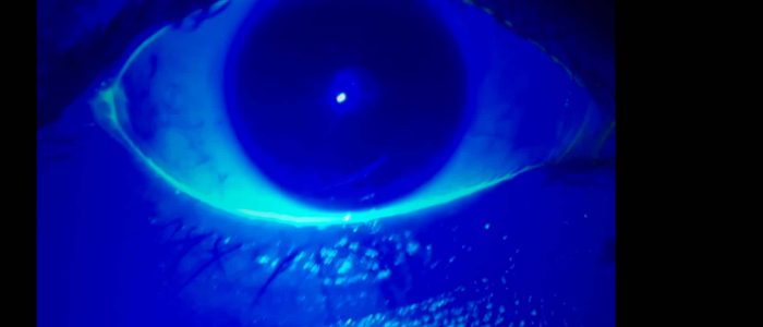 Inspect the surface of the eye using the blue cobalt light