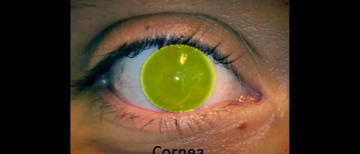 Inspect the cornea