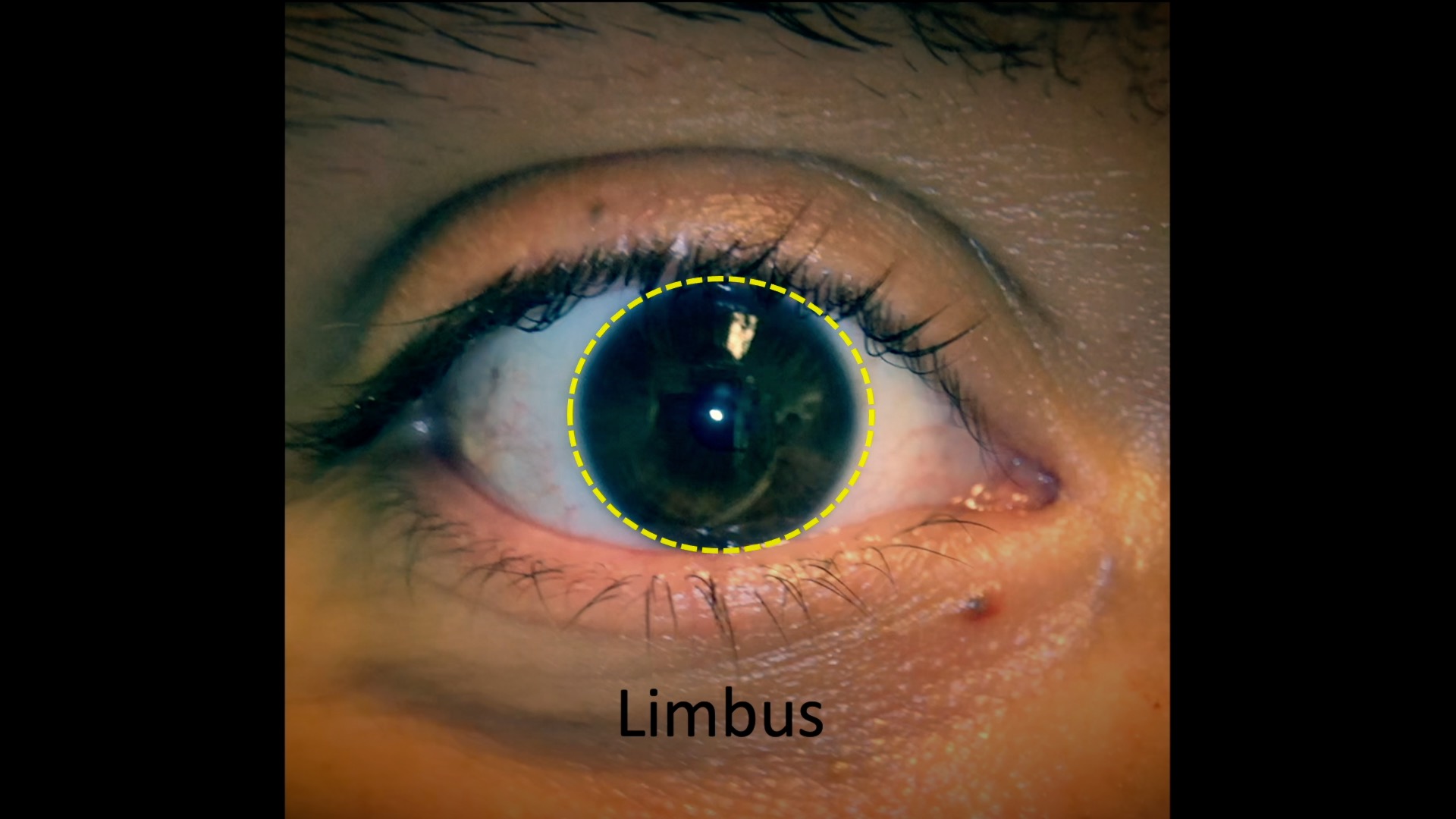 Limbus Eye