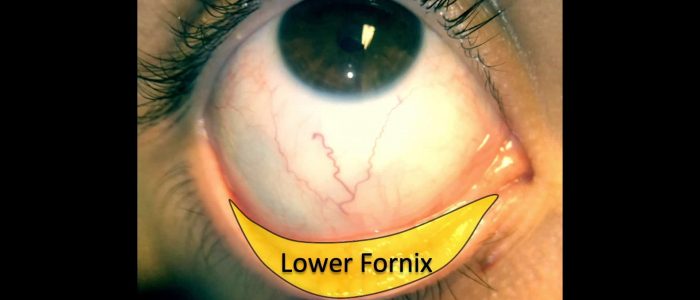 Inspect the lower fornix