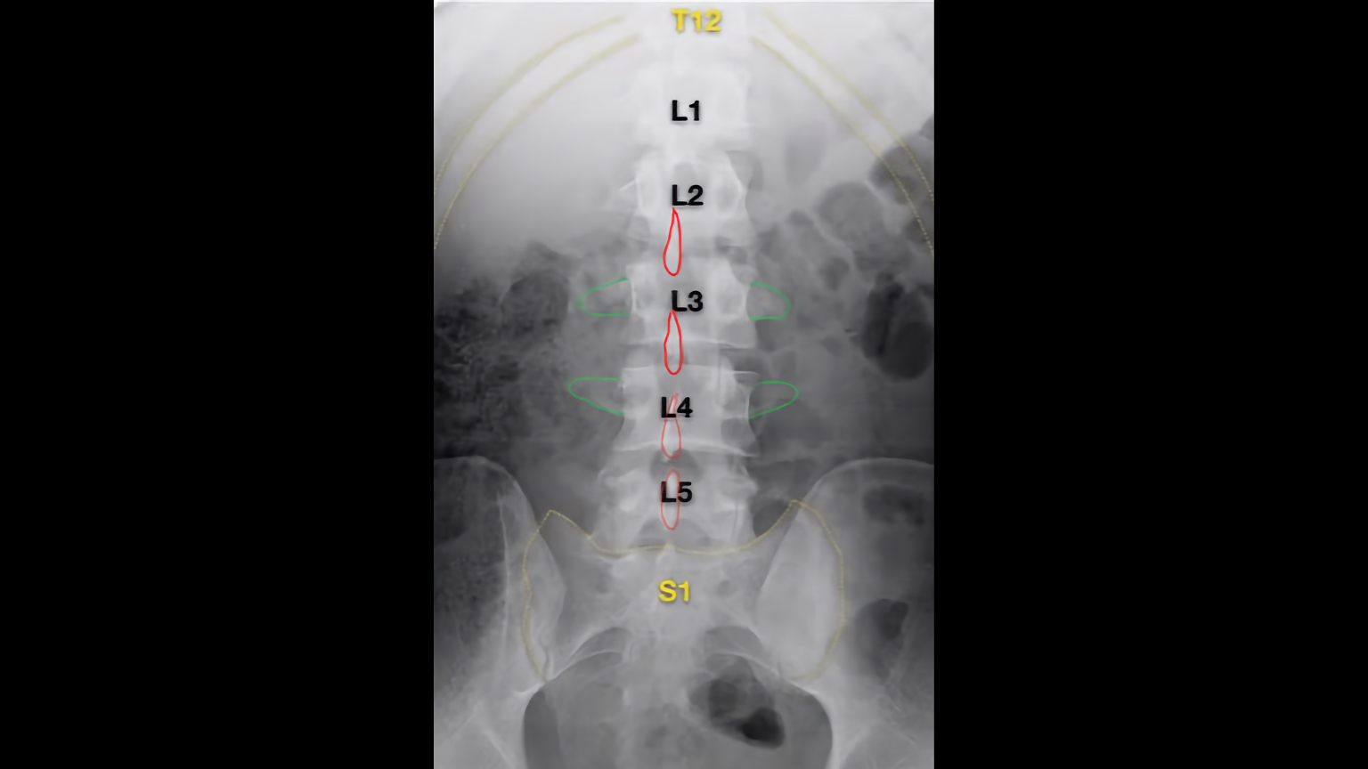 Normal lumbar spine anatomy