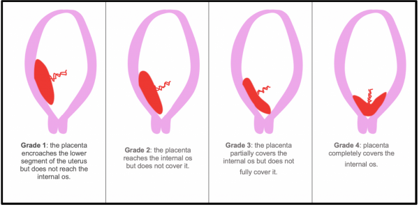 The different grades of placenta praevia.