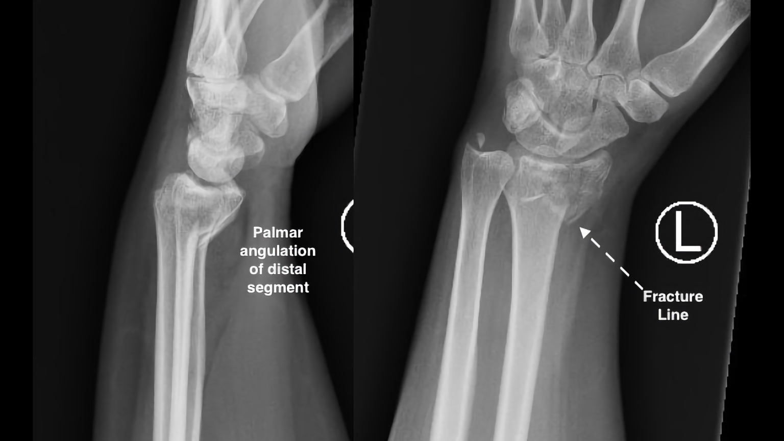 normal child wrist x ray