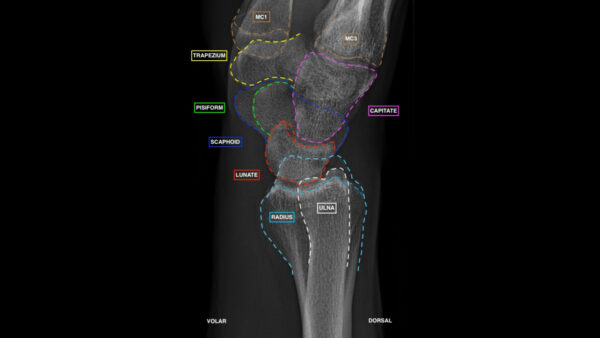 Lateral view of wrist