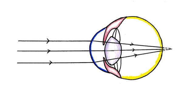 Figure 5: Uncorrected Hyperopia – Light converges too posteriorly
