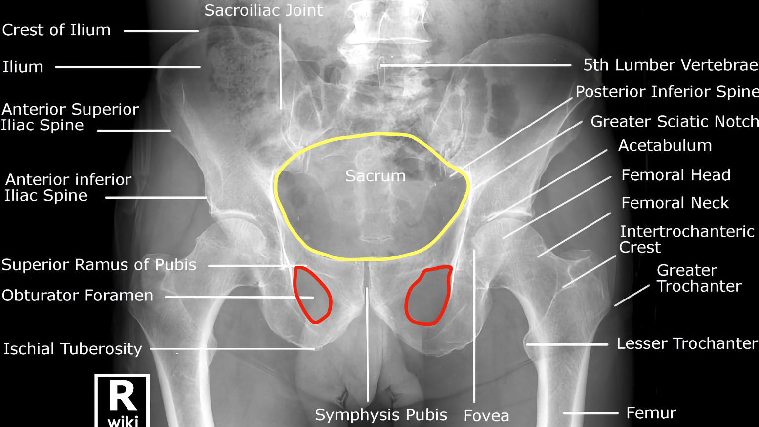 Hip X-ray Interpretation - OSCE Guide | Geeky Medics