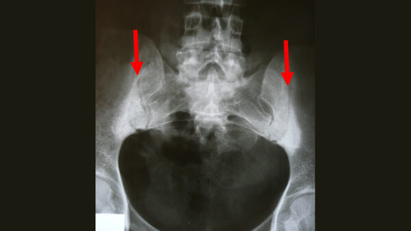Sacroiliitis x-ray