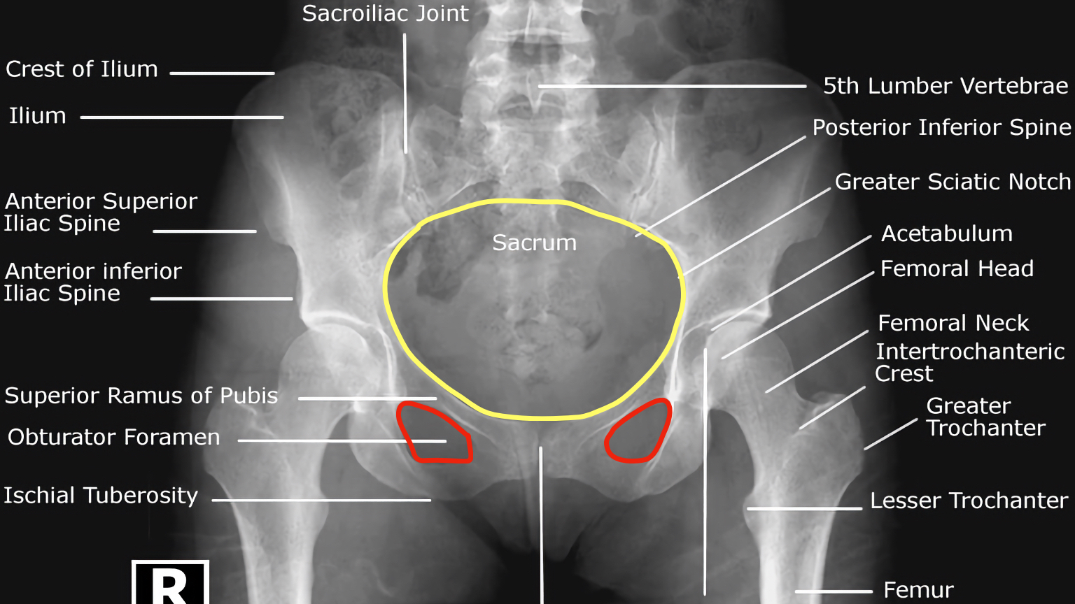 anterior superior iliac spine x ray