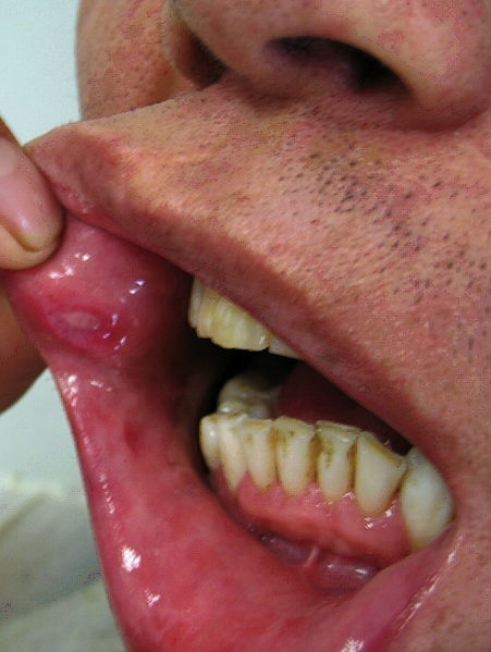 Oral ulcers seen in Behcet’s disease