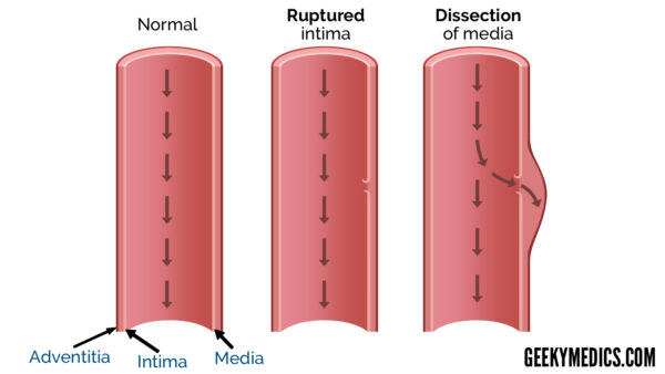 Aortic Dissection diagram