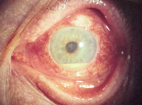 Uveitis and hypopyon in a patient with Behcet’s disease