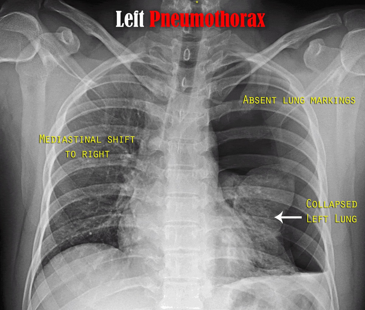 Chest X Ray Mild Pneumothorax