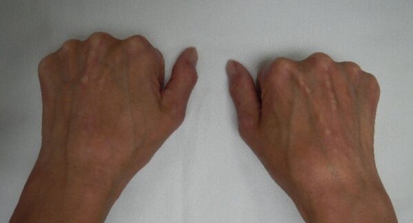 calcinosis, systemic sclerosis