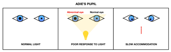  Adie's pupil