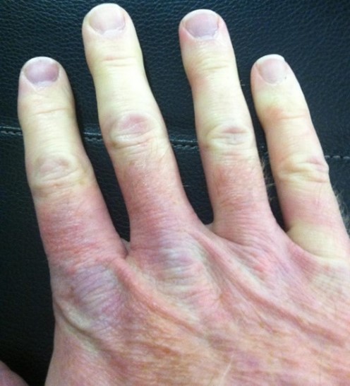 Raynaud's, systemic sclerosis