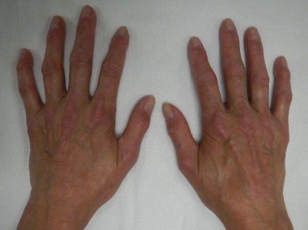 Sclerodactyly, systemic scelrosis