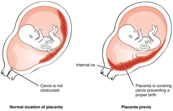 A diagram of placenta praevia