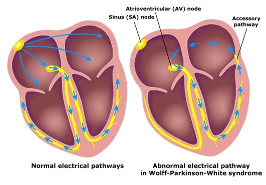 Conduction through a left-sided accessory pathway leading to pre-excitation in WPW.