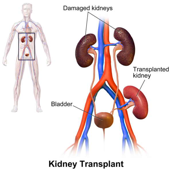 Kidney transplantation