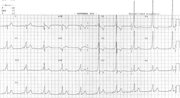 ECG showing the key features of Wolff-Parkinson-White Syndrome including a short PR interval, delta waves and broad QRS complexes.