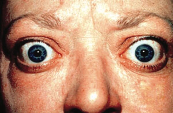 Proptosis and eyelid retraction