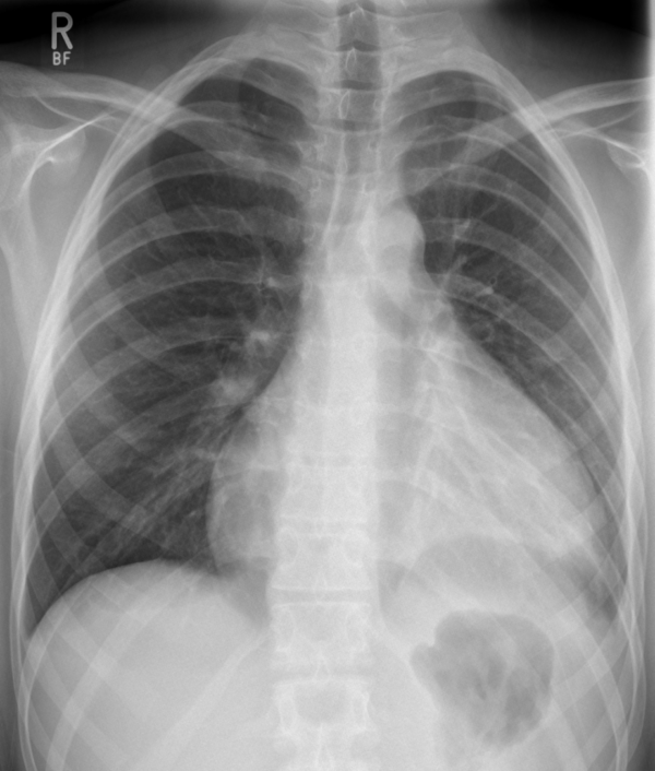 Chest x-ray showing signs of pericardial effusion (globular appearance of the heart).