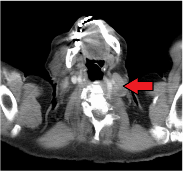 CT scan demonstrating an enlarged Virchow node