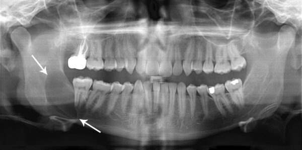 Figure 2. OPG radiograph showing the radiographic appearance a right sided odontogenic keratocyst