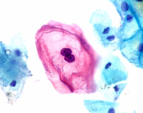 HPV-infected squamous epithelial cell (koilocyte)