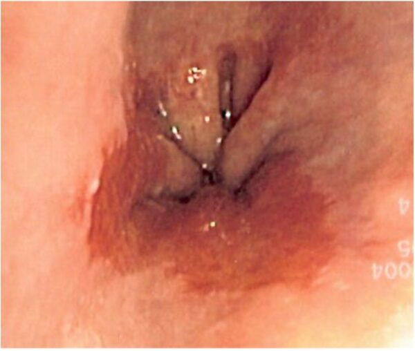 Barretts oesophagus endoscopy