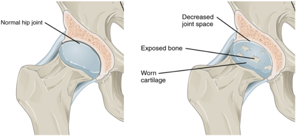 Osteoarthritis of the hip joint