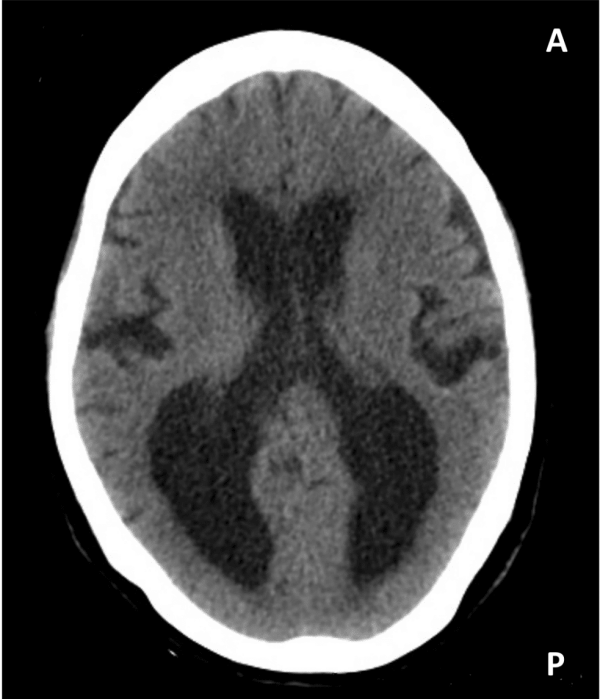 A head CT scan (axial view) from a patient with hydrocephalus, showing significantly enlarged lateral ventricles.