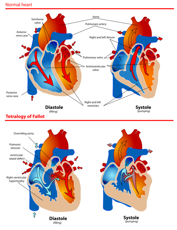 Tetralogy of Fallot blood flot