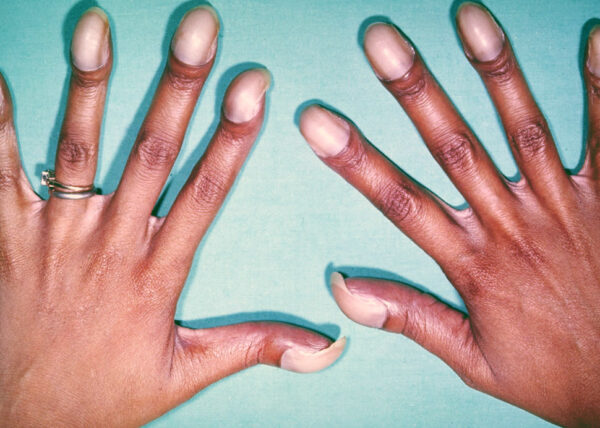Clubbing and cyanosis
