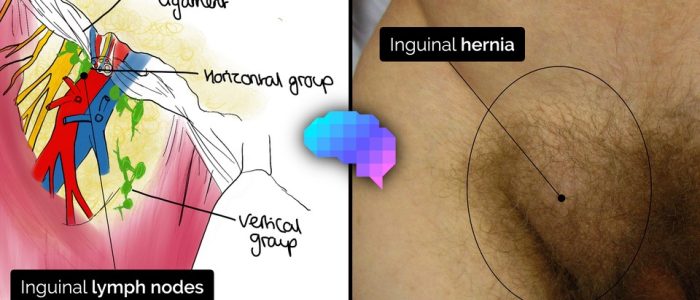 Inguinal lymph nodes & inguinal hernia examples