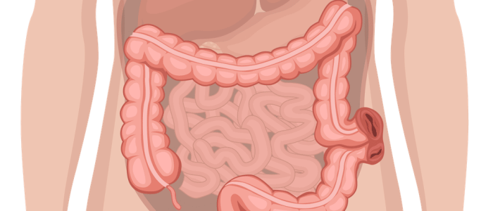 A diagram of a loop colostomy